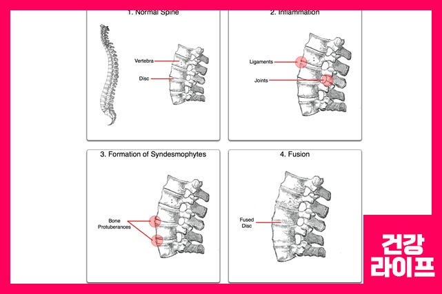 상부(경추) 척추의 척추증은 60세 이상의 사람들의 85% 이상에 영향