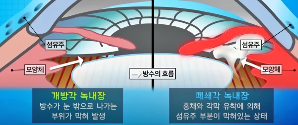 녹내장의 종류는 여러가지 기준으로 분류할 수 있습니다. 이 이미지는 그 중 가장 대표적인 종류는 개방각 녹내장, 폐쇄각 녹내장을 설명합니다.