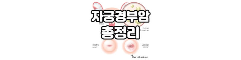 자궁경부암 - 요약