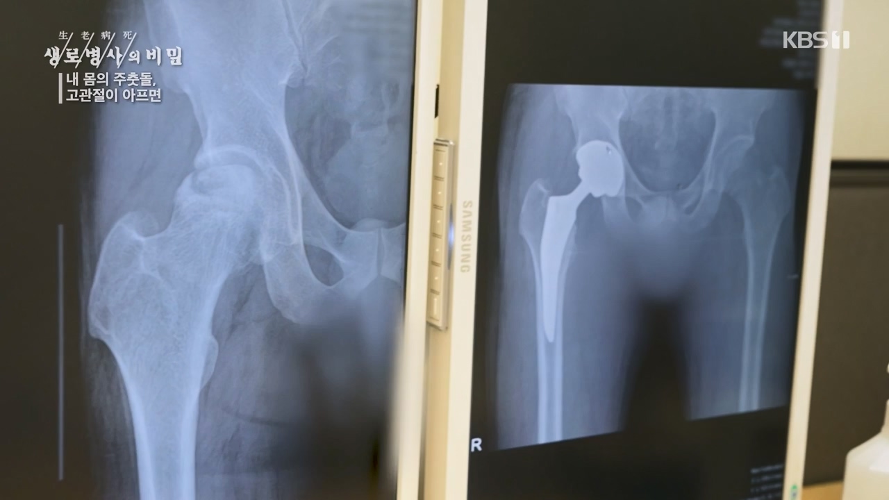 생로병사의 비밀.E890.231116p-NEXT.mp4_20231116_204855.830.jpg