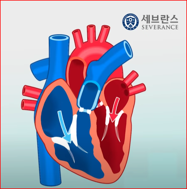 출처; 유튜브 오건강, 조선일보 의학건강, 세브란스와 함께하는 심장건강 지키기