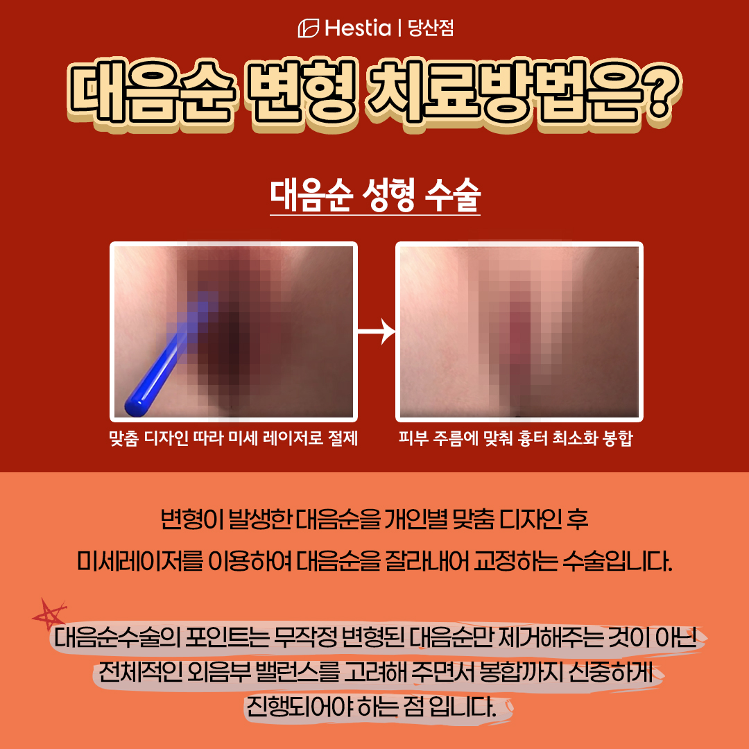 대음순 변형 치료법은?