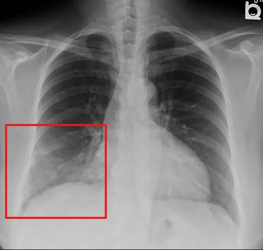 mucinous BAC : consolidation with airbronchogram 