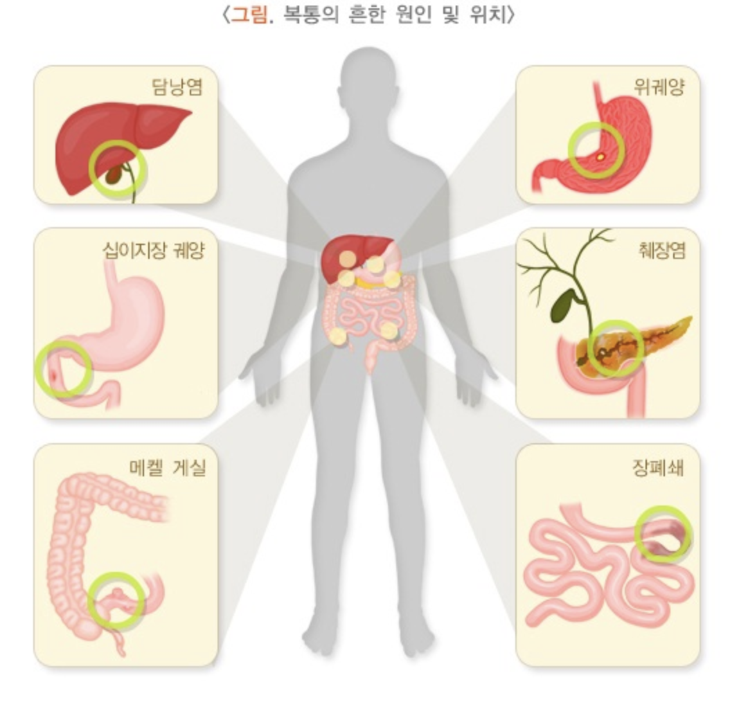  급성 복통 원인은 왜?? 배가 갑자기 아파요