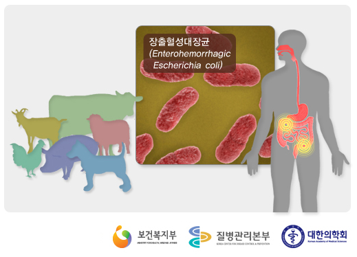  햄버거병, 용혈성요독증후군? 장출혈성대장균 감염증?