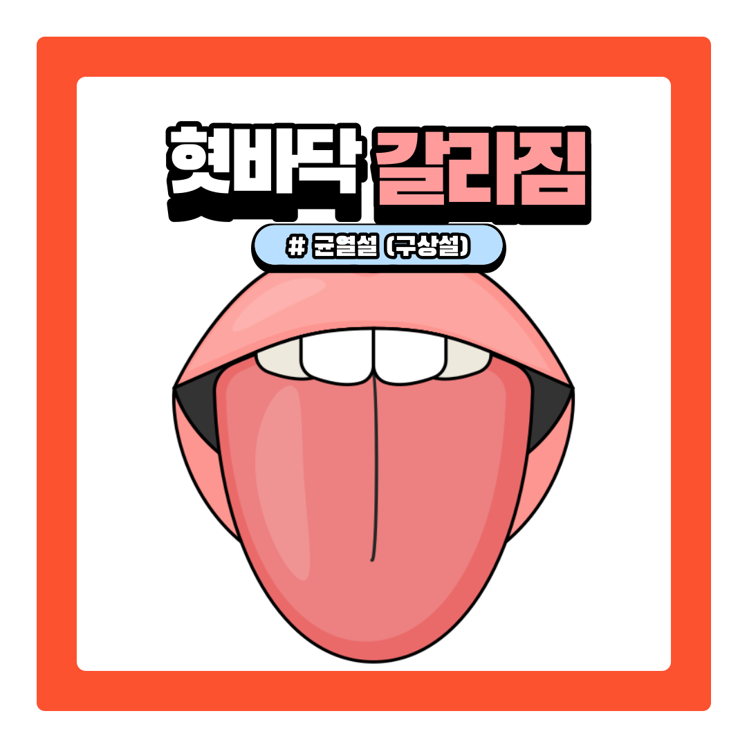  혓바닥 갈라짐 균열설 원인과 치료 방법 알아보기