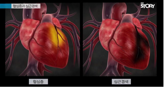 심혈관-질환-증상-심근경색-동맥경화-콜레스테롤-관계