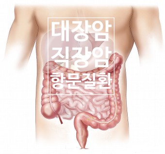 대장암초기증상
대장암에 좋은 음식