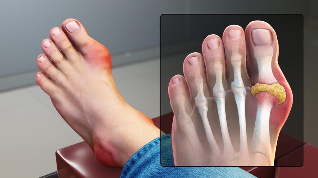  통풍(Gout), 증상 없어도 평생 관리해야..."술은 무조건 금주"