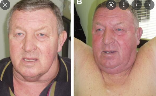 SVC syndrome : 얼굴이 붓고 목정맥이 커지고 붉어진다.