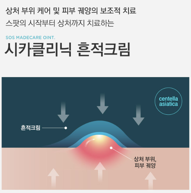 여드름 자국 &amp; 붉은기 없애는 토소웅 흔적 크림 추천!(효과&amp;#44; 성분&amp;#44; 후기)