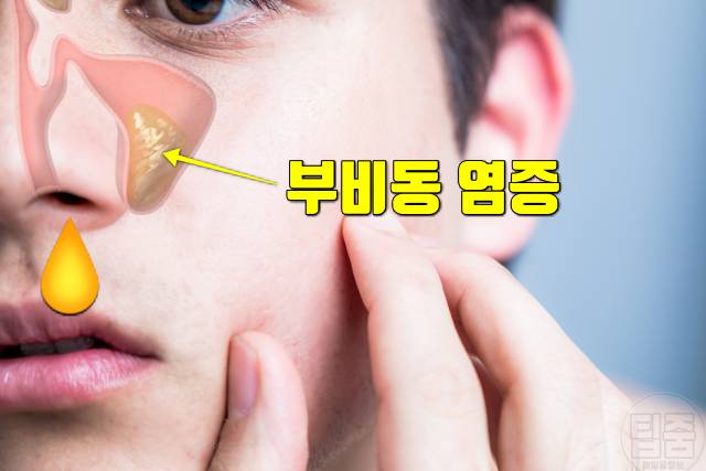 콧물 목 뒤로 넘어가요 후비루 원인 부비동염 축농증