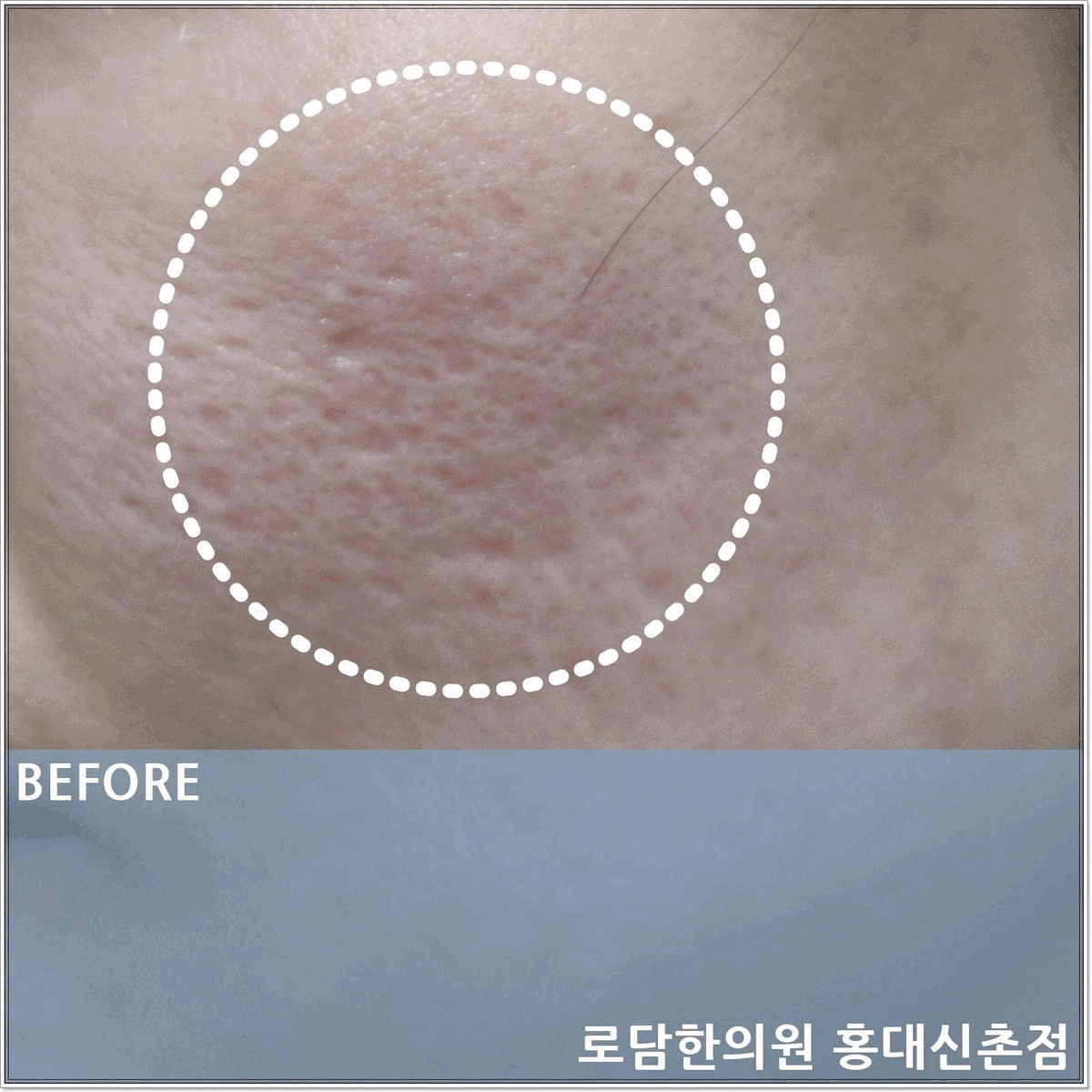  신촌 여드름 흉터 패인 자국 제거 새살침