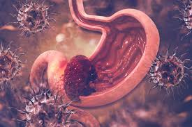  위암(gastric cancer)이란?
