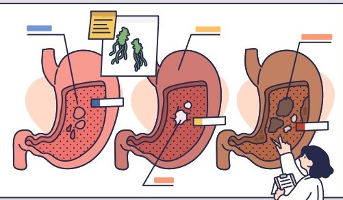 헬리코박터 제균치료 이미지