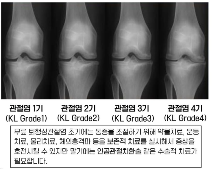 관절에 좋은 음식