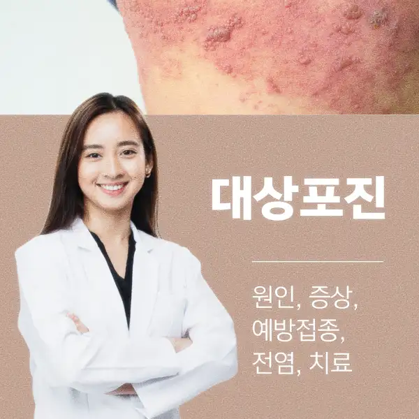 대상포진 원인, 증상, 예방접종, 전염, 치료