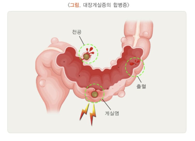 대장게실의 합병증