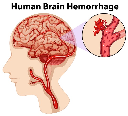 brain-hemorrhage