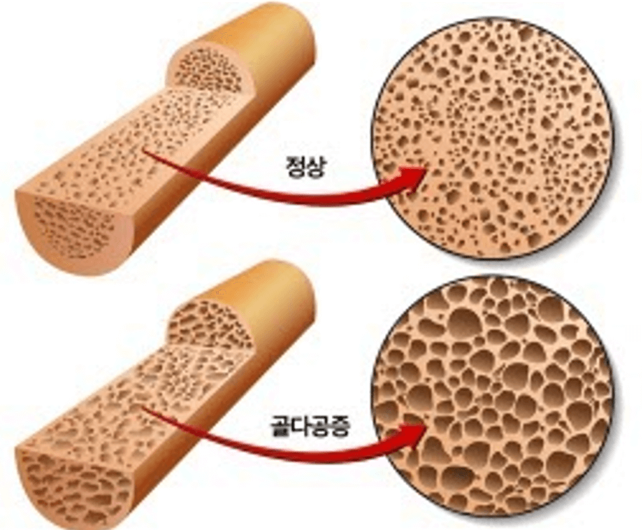 정상-골다공증-비교-사진