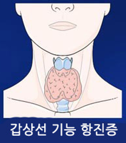 갑상선 기능 항진증