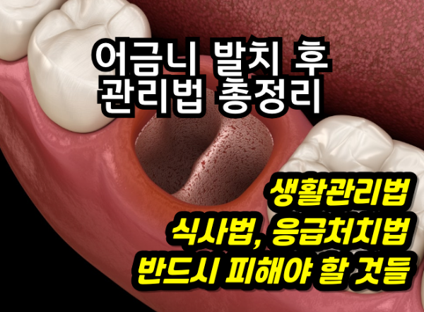 어금니 발치 후 관리법