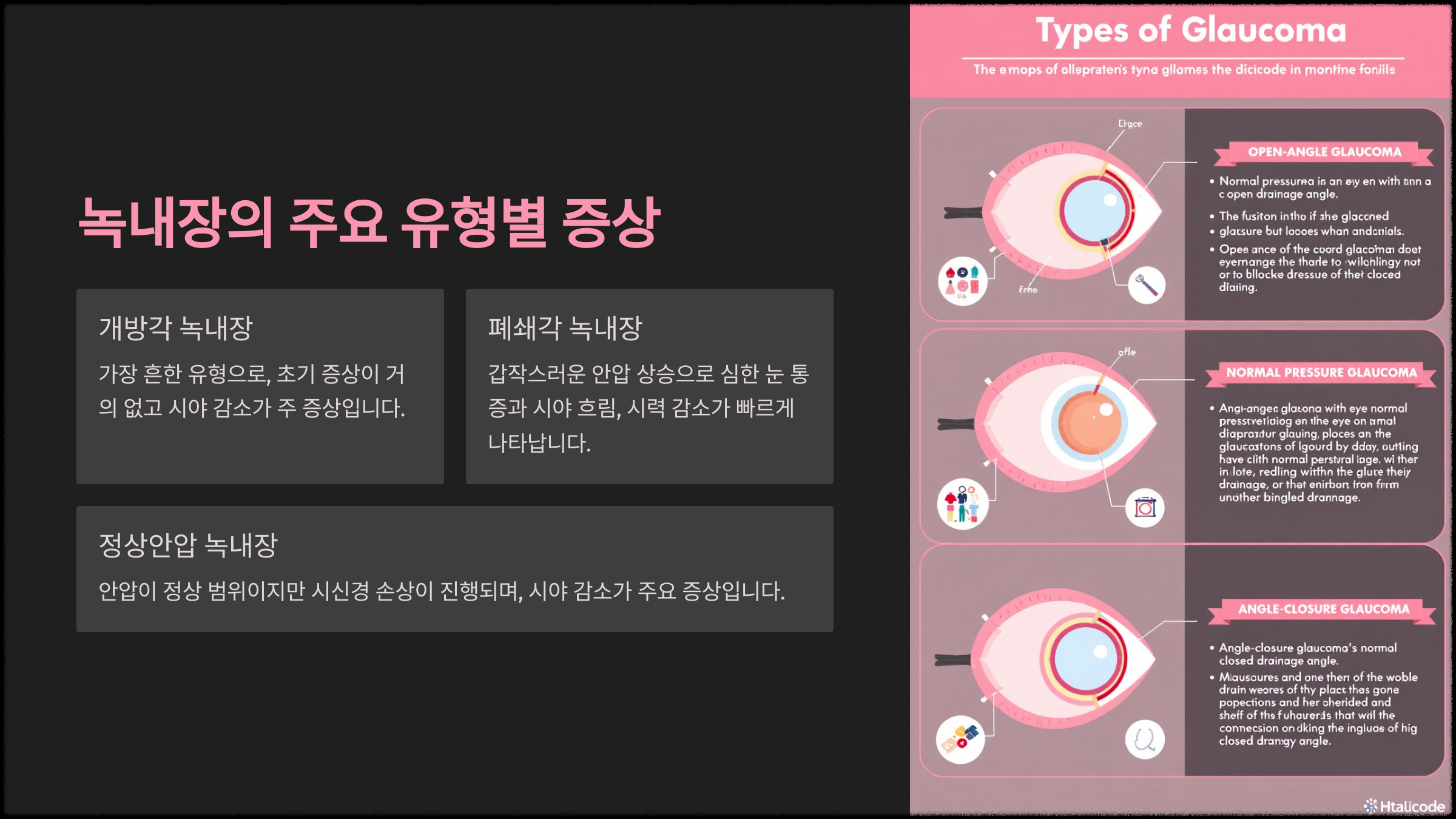 녹내장의 초기 증상 중 시력 감소도 있나요?