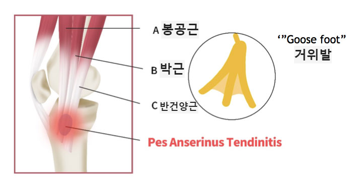 거위발건염