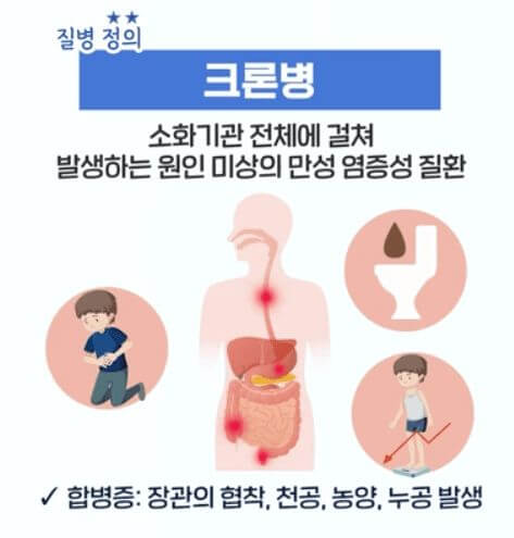 크론병 증상