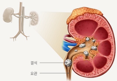 요로-결석이-요관을-막고-있는-그림