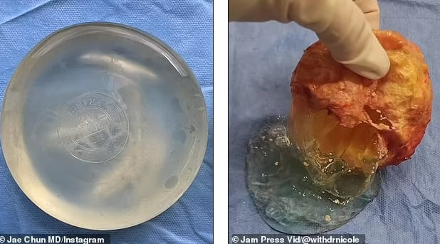 이런! 성형 시술 의사가 10년 후 고객의 유방 보형물을 꺼냈더니..VIDEO: TikTok surgeon removes woman&#39;s 35-year-old breast implants