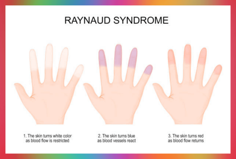 레이노 증후군 3단계 변화