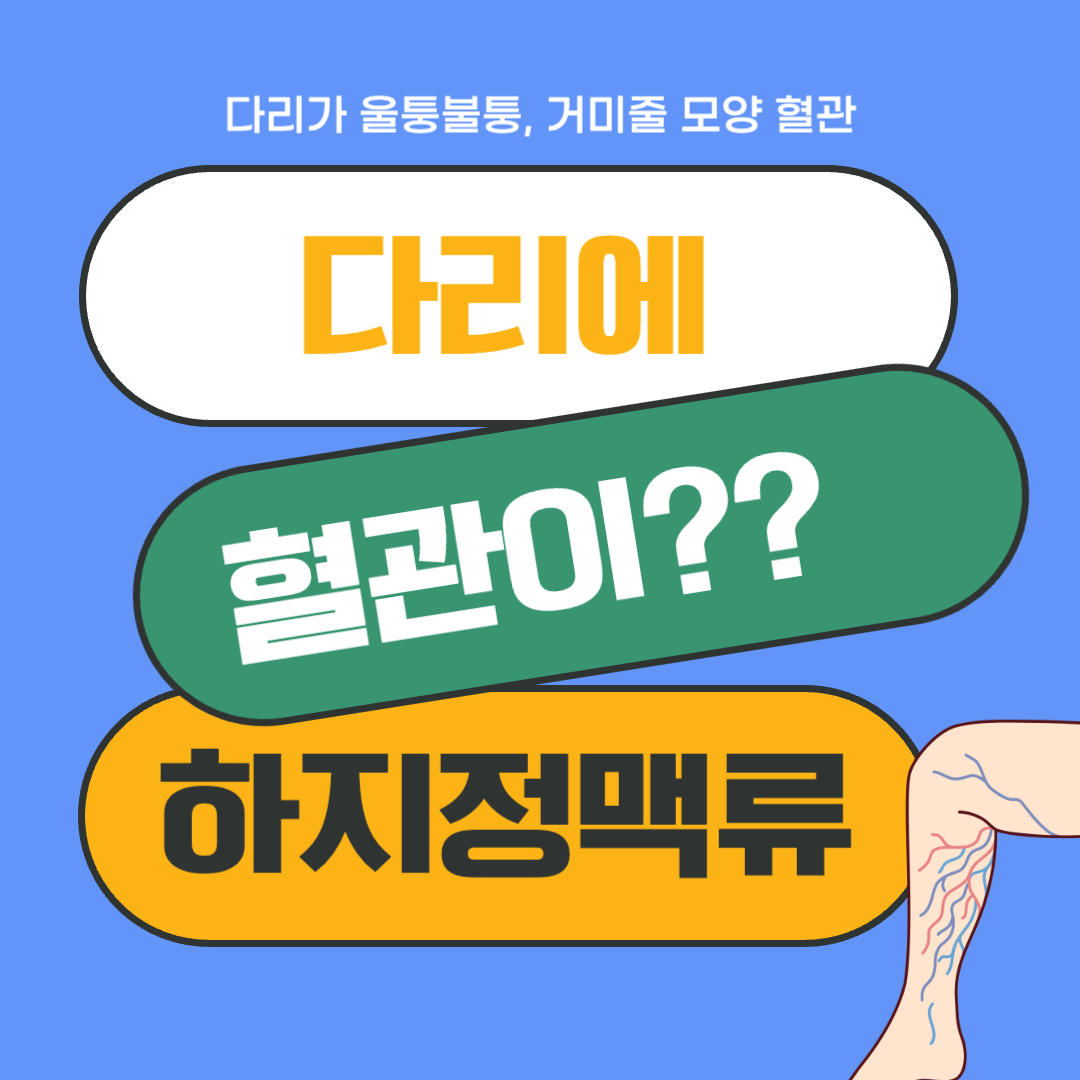  다리에 혈관이 튀어나와요? 하지 정맥류를 의심하자