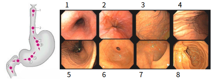 위내시경-표준-촬영-부위-8장