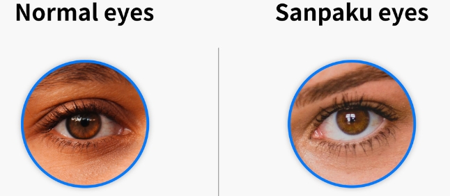 일반적인 눈과 삼백안