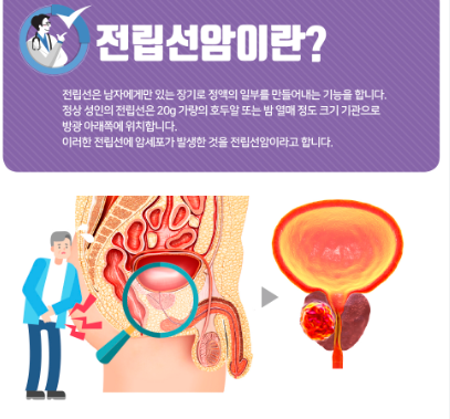 전립선암 진단