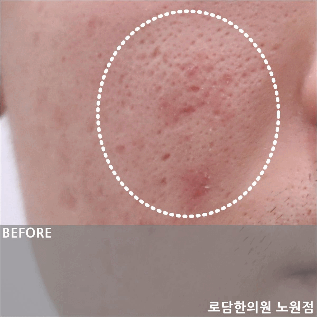  의정부 여드름 흉터 패인 자국 제거 새살침 치료 과정