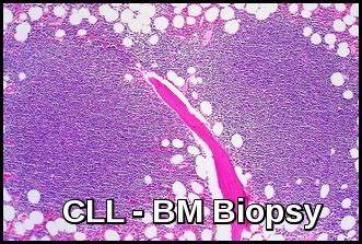 만성 림프구성 백혈병(CLL)의 Rai/Binet 병기 분류 체계