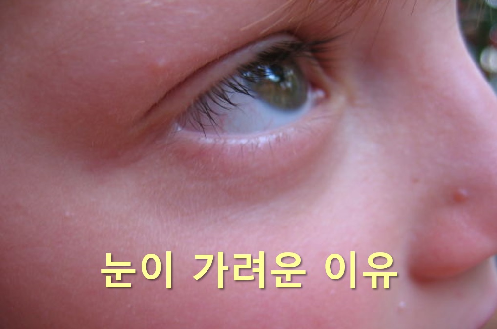  눈이 가려운 증상과 눈이 가려운 이유