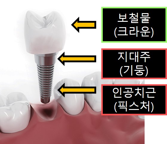 임플란트 구조