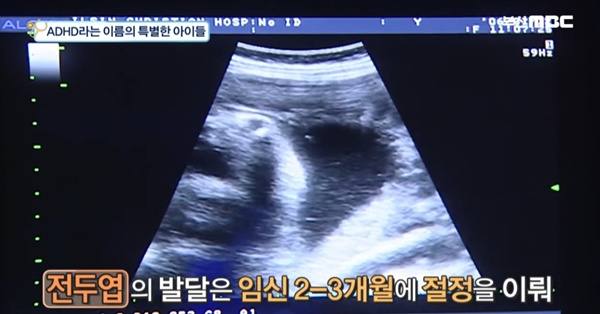 아동ADHD-의심-증상