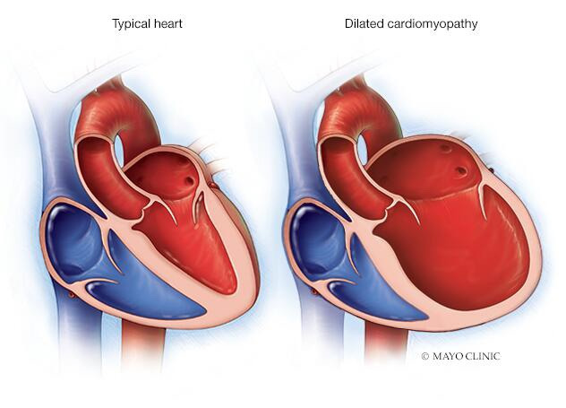 DCMP versus normal heart morphology