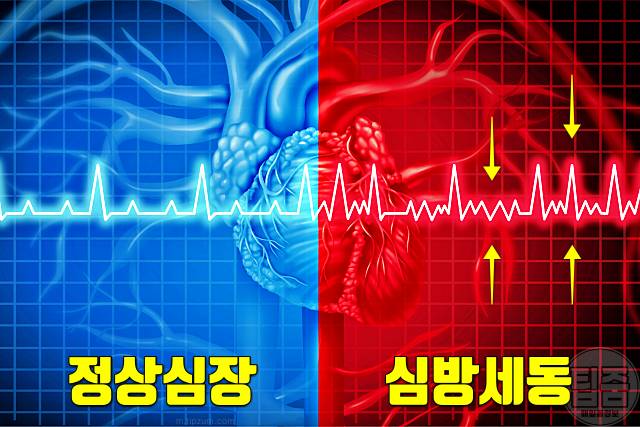 심장이 불규칙하게 뛰는 이유 심방세동 부정맥 원인