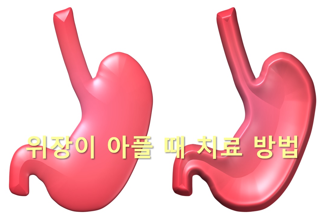  위장이 아플 때와 위장이 부었을 때 치료 방법