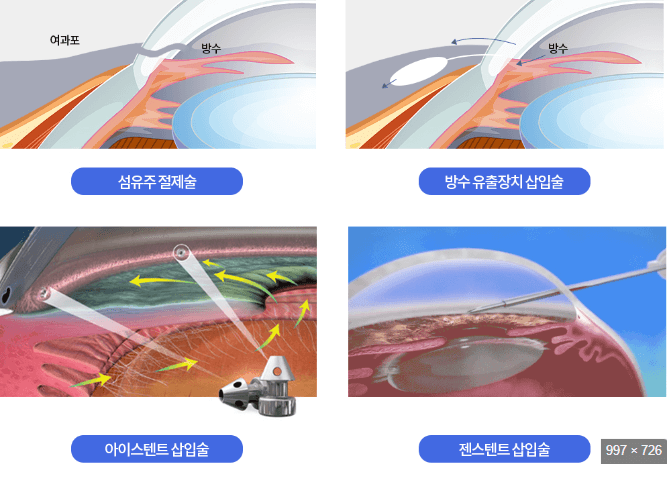 녹내장수술치료법안내