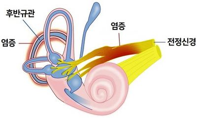 전정신경염 증상