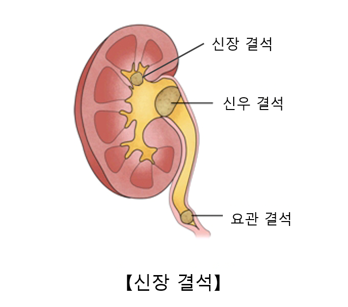 신장결석