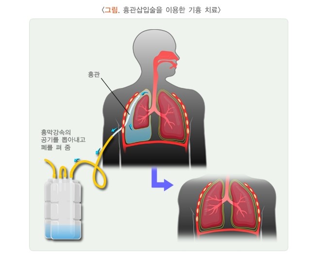 기흉수술