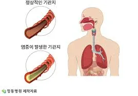 폐렴 초기증상