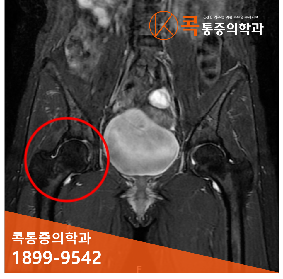 고관절 통증 증상 수지구청정형외과 허리골반통증, 고관절 6